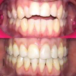 Invisalign braces teeth invisible clear dental straighten