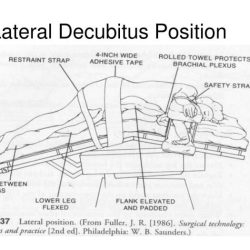 Left lateral decubitus position x ray